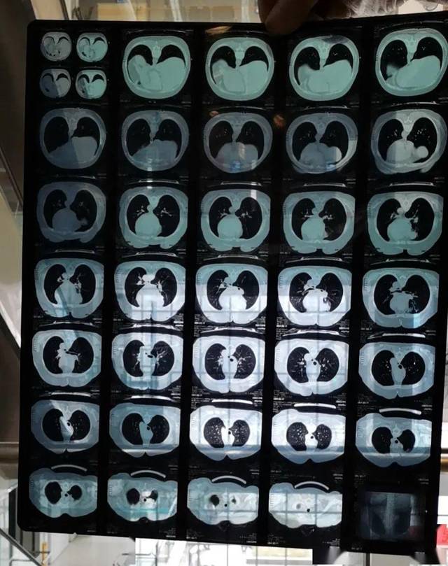 肺腺癌晚期,已经骨转移,吃凯美纳好嘛?听说耐药性短