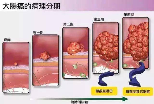 甲状腺癌成深圳女人新"癌王"!最新肿瘤榜,又有2.8万人