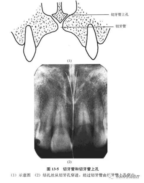 切牙管上孔:共2个,位于鼻前唇底,与鼻中隔邻接,根尖片上切牙管上孔的