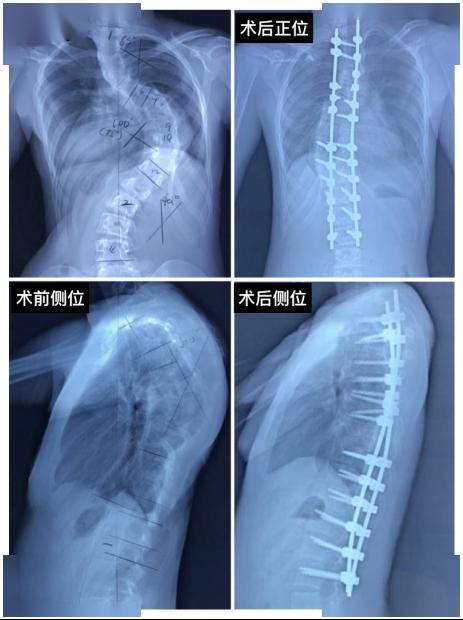 脊柱侧弯患儿脊柱正侧位x线检查术前术后对比