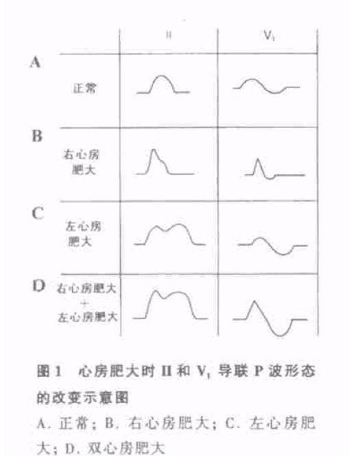 【"心电图解读"讲座系列】第 5 讲:心房及心室肥大心电图