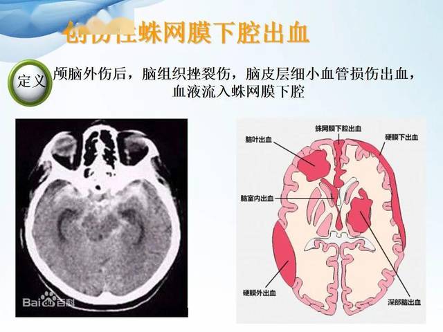 【ppt】创伤性蛛网膜下腔出血的护理