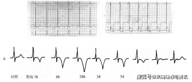 不同波形变化心电图大汇总