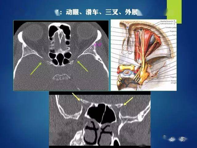 c,高分辨率示踪视觉通路,可以呈现出鼻侧视神经,颞侧视神经,视交叉,视