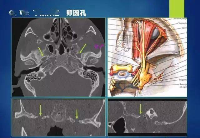 c,高分辨率示踪视觉通路,可以呈现出鼻侧视神经,颞侧视神经,视交叉,视