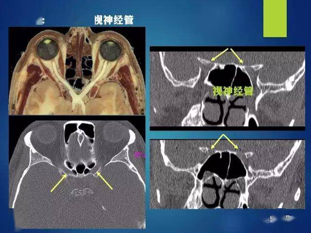 c,高分辨率示踪视觉通路,可以呈现出鼻侧视神经,颞侧视神经,视交叉,视