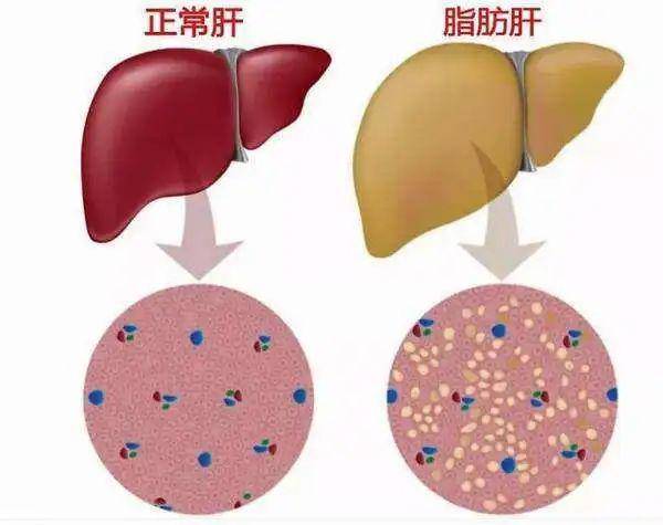 凌驾10%为中度脂肪肝;  ●凌驾25%为重度脂肪肝