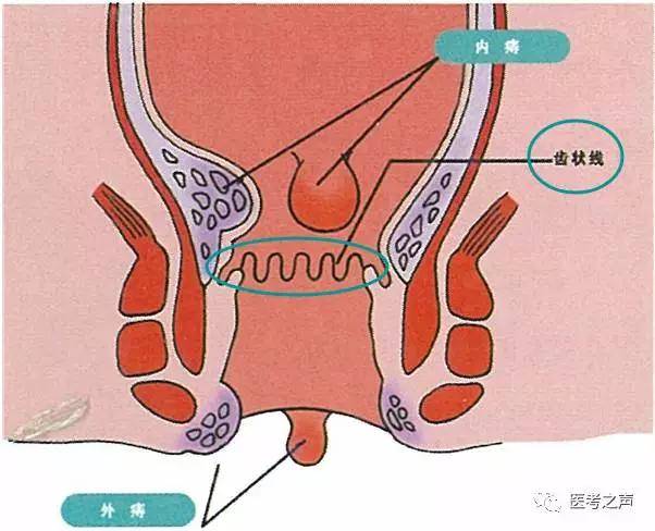 青岛京北肛肠医院带你看图秒懂内痔,外痔和混合痔的区别