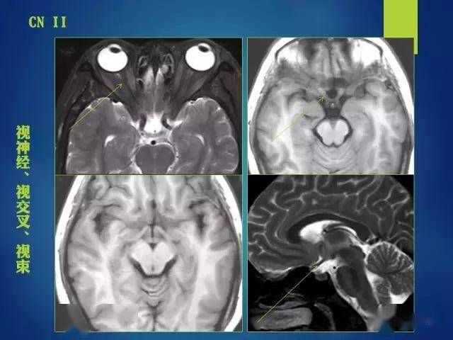 可以呈现出鼻侧视神经,颞侧视神经,视交叉,视束,视放射;d,对应的解剖