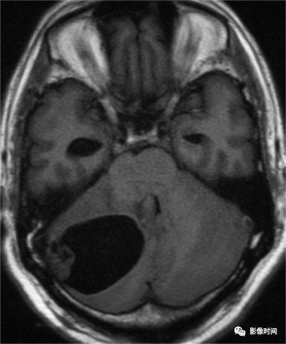 后颅窝常见肿瘤的 mri 表现,精彩不会错过