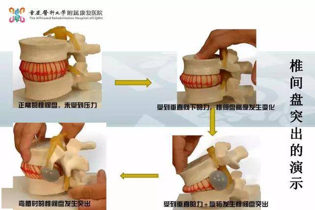 腰椎间盘突出不能盲目锻炼!重医附属康复医院医生这样