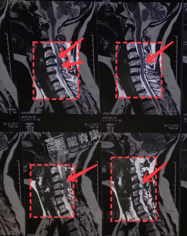 28外院颈椎mri报告示:c4/5,c5/6椎间盘向后突出,c6/7椎间盘向后轻度