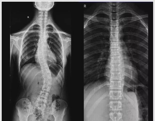 医生会凭据孩子整体情况及x光片所示的脊柱侧弯角度的巨细为孩子制定
