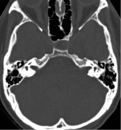 术前岩骨薄层扫描ct示内听道显著扩大