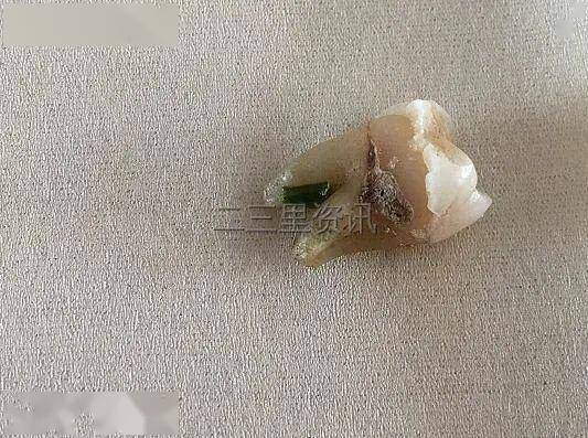 据牙医介绍,这颗牙齿确定是人的牙齿,是后槽牙,看外形是拔出来的.