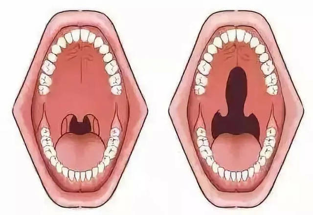 韩素勤介绍,唇裂和腭裂是口腔颌面部常见的先天性畸形,可单独发生也