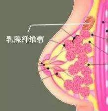 乳房一摸疙疙瘩瘩原来是纤维瘤