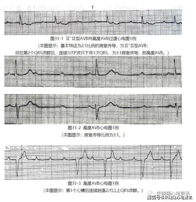 房室传导阻滞(二)