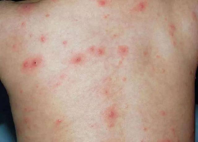 水痘是属于急性传染病,  婴幼儿和  学龄前儿童中很常见
