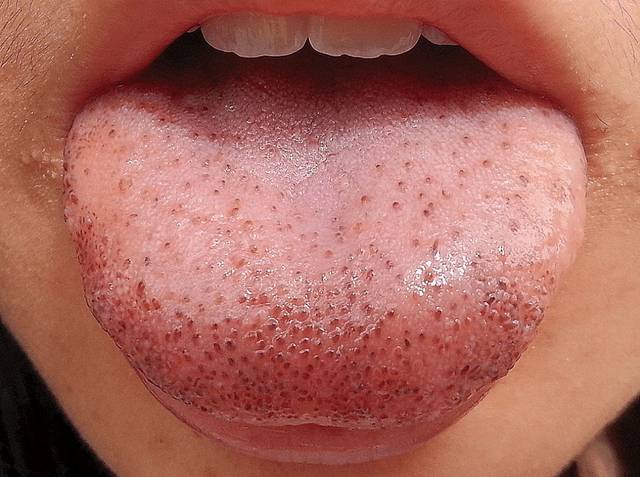 二 血瘀体质的舌象 如果你的舌头颜色出现这种黑的点,或者青的点,那