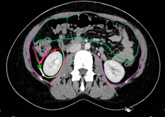 跟着ct/mri学超声:小视频——腹膜后间隙与肾周筋膜