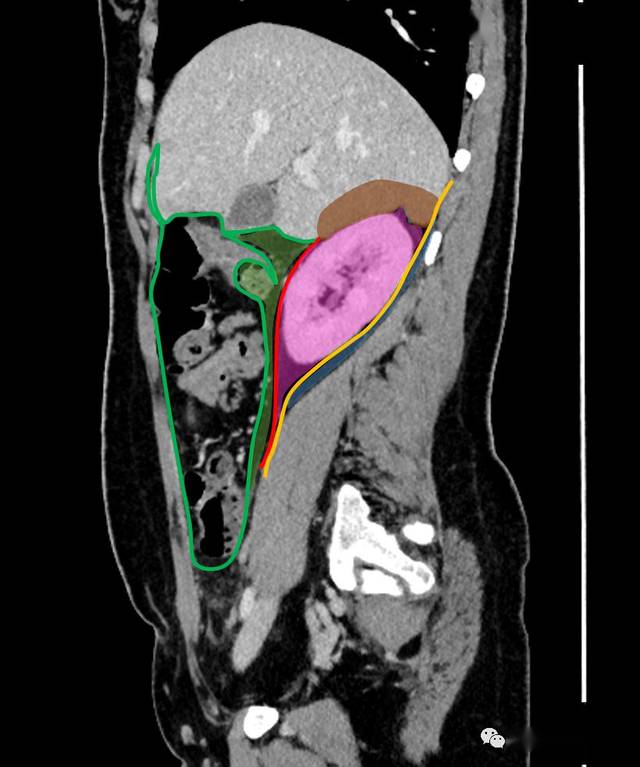 跟着ct/mri学超声:小视频—腹膜后间隙与肾周筋膜