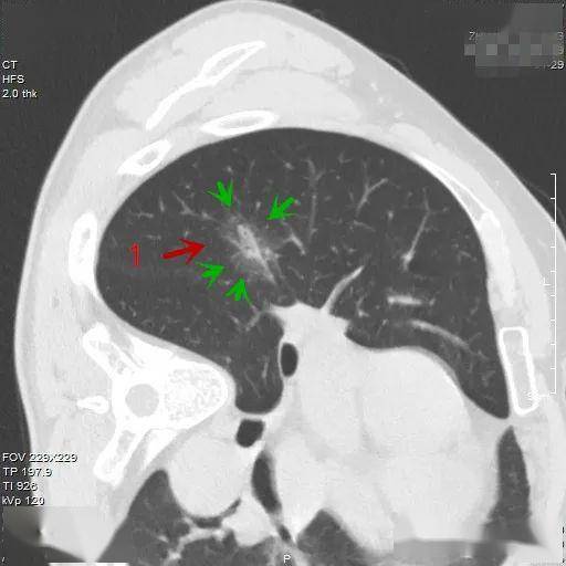 经验积累:看了此例,以后还真不敢说从影像能判断肺癌的类型!