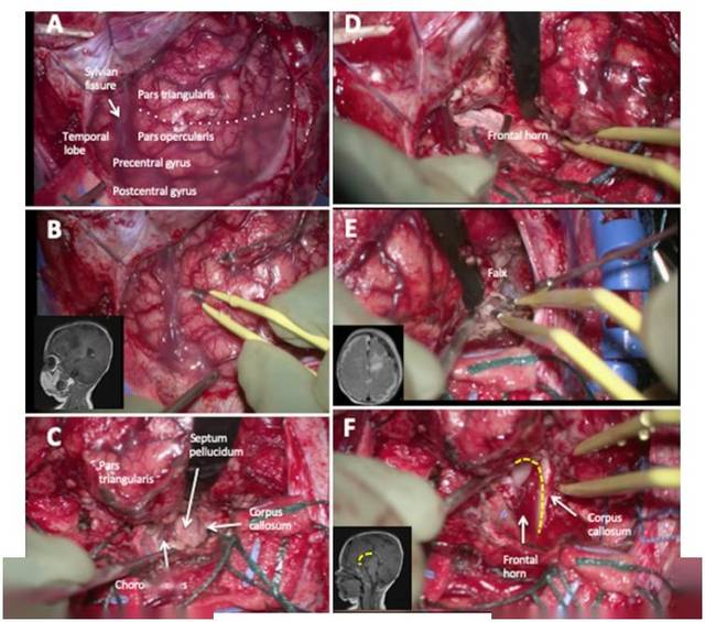 单侧前额叶切断术治疗难治性癫痫及其相关解剖
