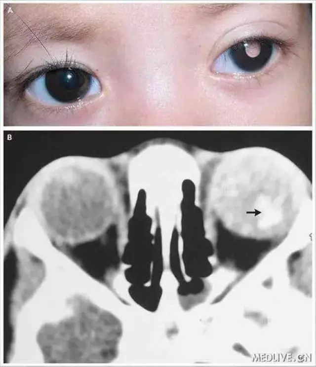 结果非常遗憾,原来宝宝得的是眼内恶性肿瘤——视网膜母细胞瘤