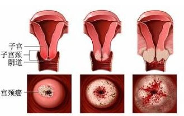 宫颈癌的各期症状 你知道有哪些吗