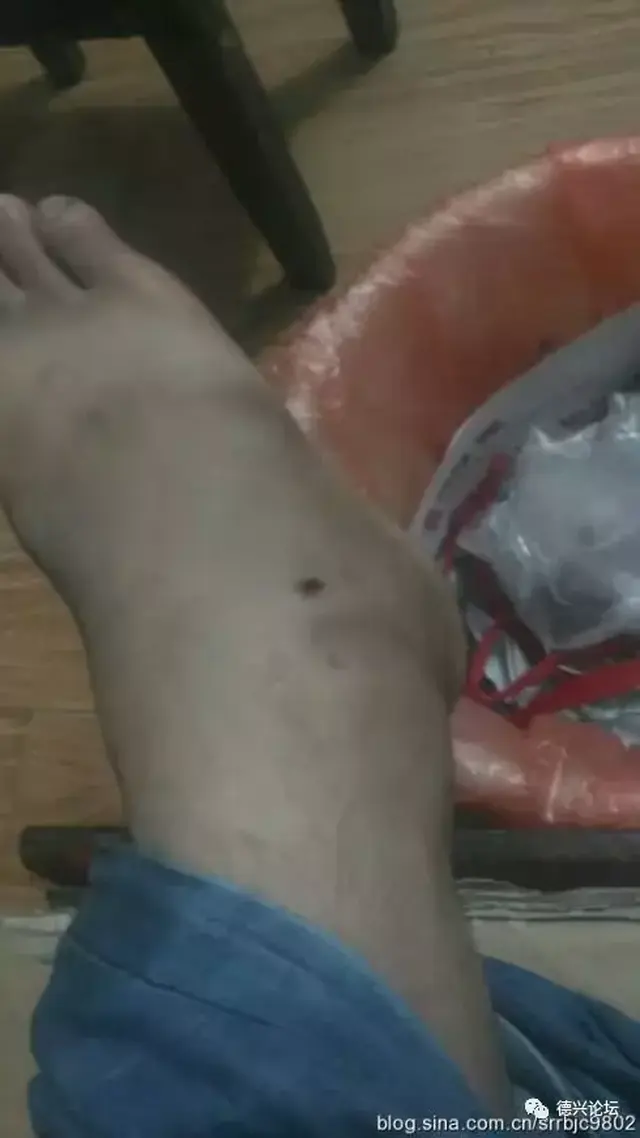 德兴一学生被五步蛇咬伤 脚肿的像萝卜一样大!
