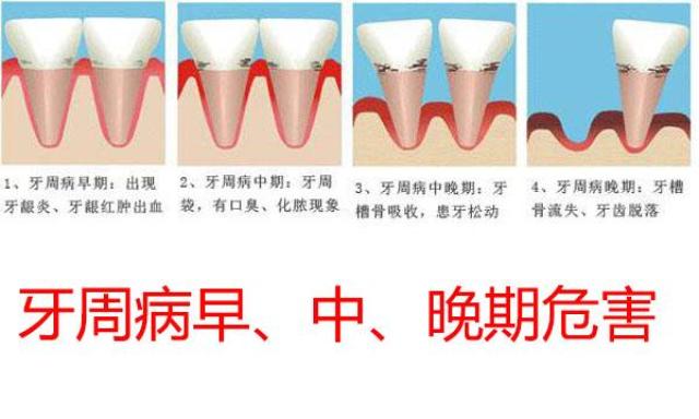 牙周病总治不好,要注意了,你有可能是得了糖尿病