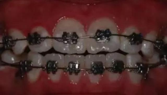 哪种牙套适合你?听听正畸医生怎么说