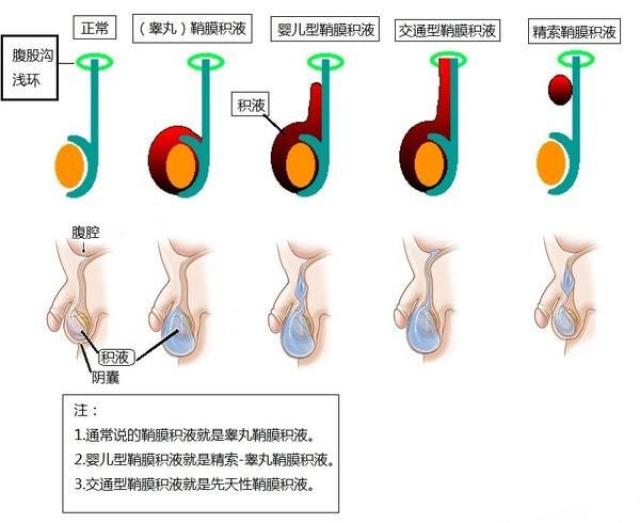 请点击此处输入图片描述 请点击此处输入图片描述 鞘膜积液分为交通