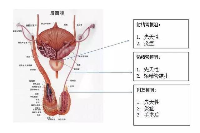 梗阻性无精子症 有希望治愈的疾病