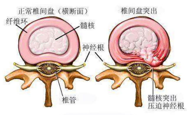 腰椎间盘突出了,推拿可以按回去吗?这里告诉你