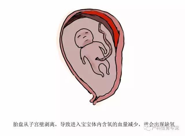 什么样的孕妈妈容易发生胎盘早剥?