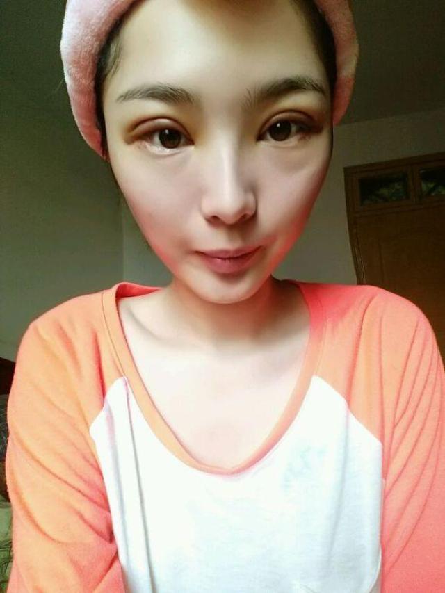 全切双眼皮恢复一个月半,都说比较自然了,嘻嘻