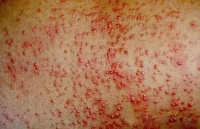 急性发病,皮损为成批出现圆而尖形的针头大小的密集丘疹或丘疱疹,周围