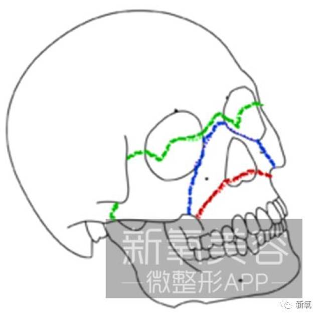 红线为lefort i型截骨,刚刚解说过了.