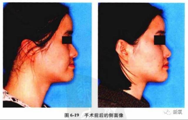 首先lefort i型截骨法,是lefort里面术区最小的,也是最常用的截骨法