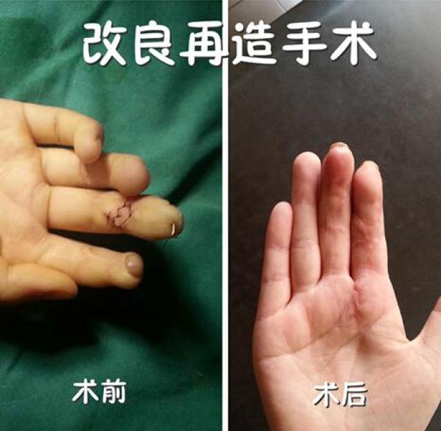 比如:小耳晃庹偕魅:"手指再造",是将脚趾移植到缺失的手指,满足手