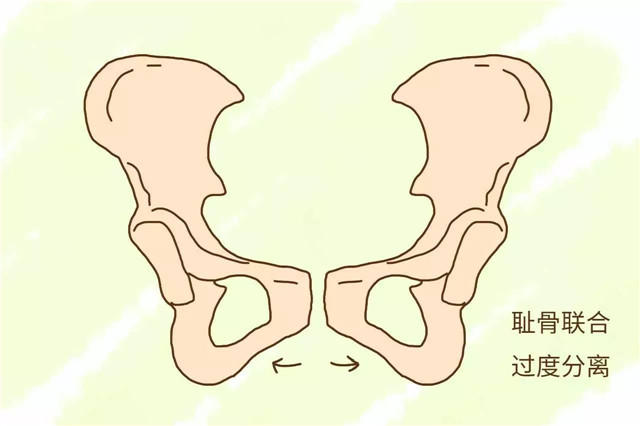 孕妈之所以会感到大腿根部疼痛,是因为耻骨联合过度分离造成的.