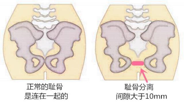 这女星真倒霉,怀孕怀到只能坐着睡!小心耻骨分离