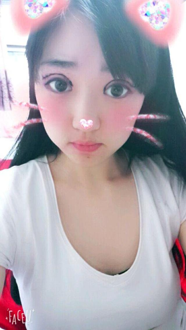 割双眼皮,这样是失败了还是因为眼睛太肿了啊