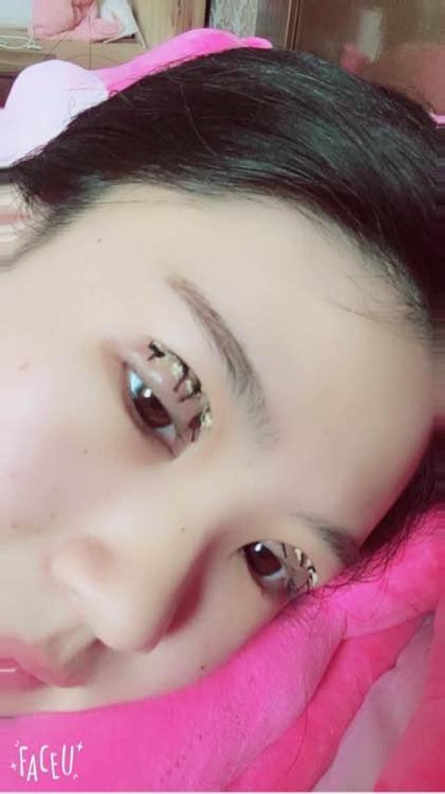 我做的是韩式仿真双眼皮十天拆线,恢复真的很好看