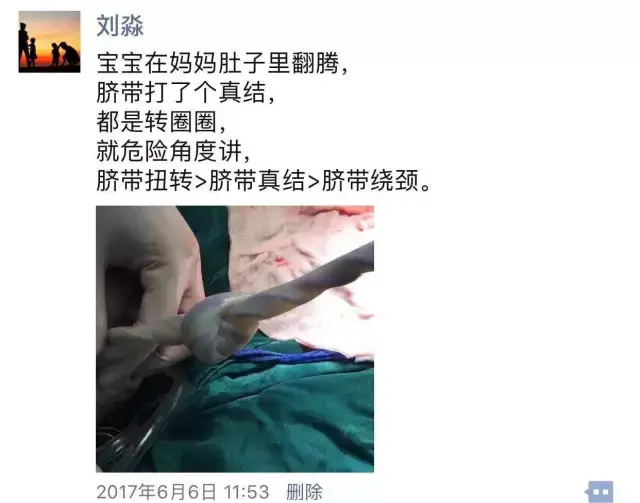 脐带扭转周数>11周,我们称为脐带过度扭转或者高螺旋脐带,产科医生