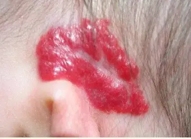 多出现在面部和颈部,且面积比较大,暗红色斑是由毛细血管扩张引发