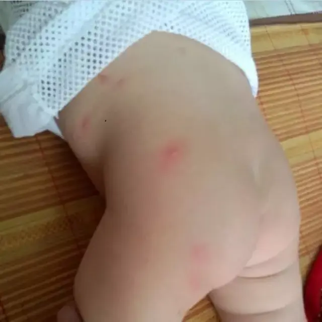 小孩都是差不多的症状,基本是床上螨虫造成的过敏,现在夏季来临,都换