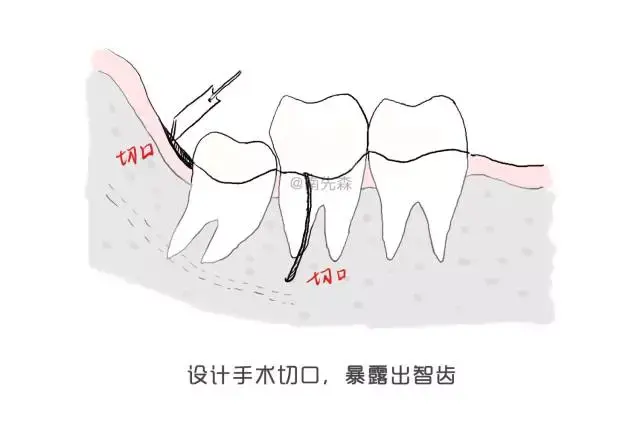 如果智齿埋伏阻生,首先应该设计手术切口,暴露出智齿.